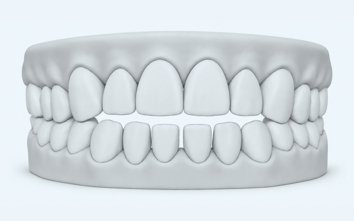 Illustration of an open bite