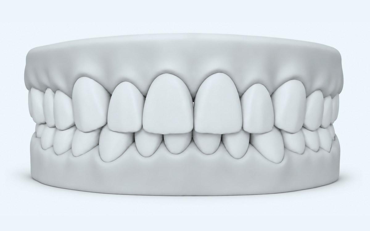 Illustration of an overbite