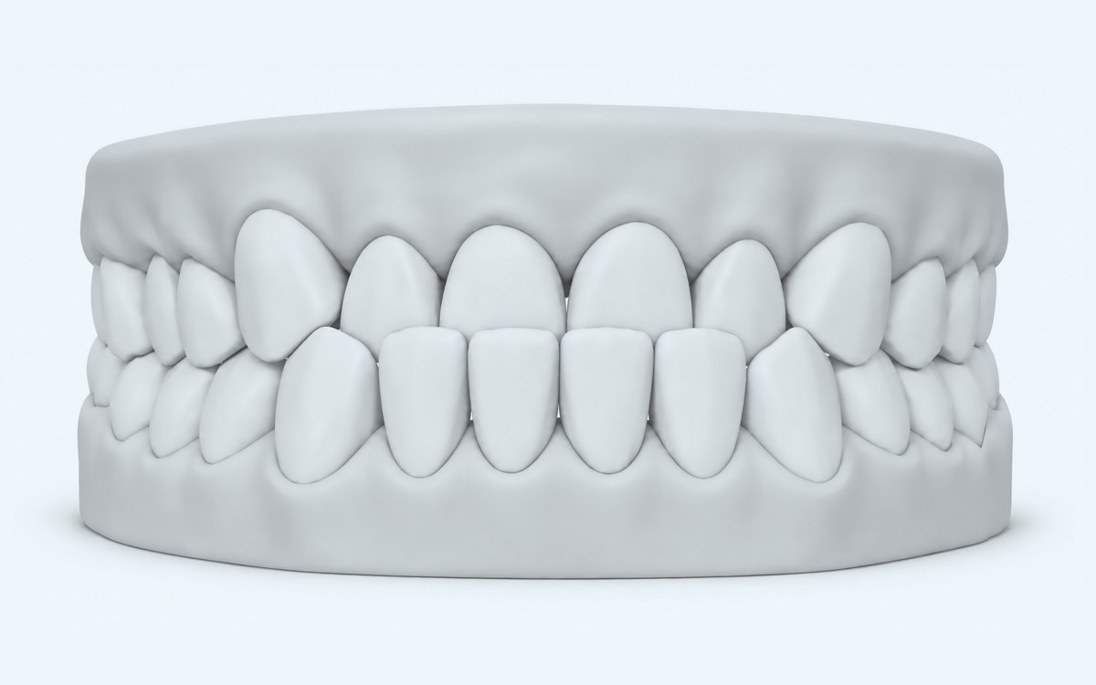Illustration of an underbite