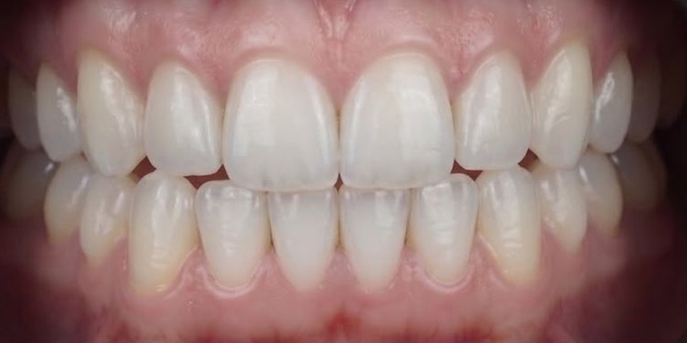 After Active Aligners treatment, front view, treated by Dr Vikash Naidoo