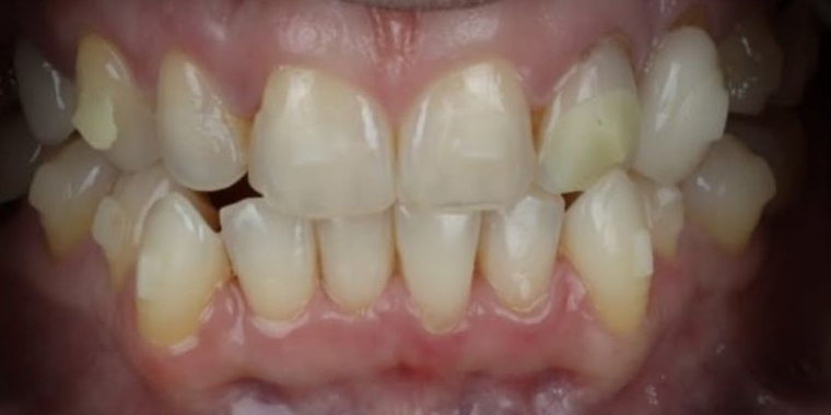 Before Active Aligners treatment, front view, treated by Dr Vikash Naidoo