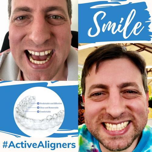 ACTIVE ALIGNERS - Before and After