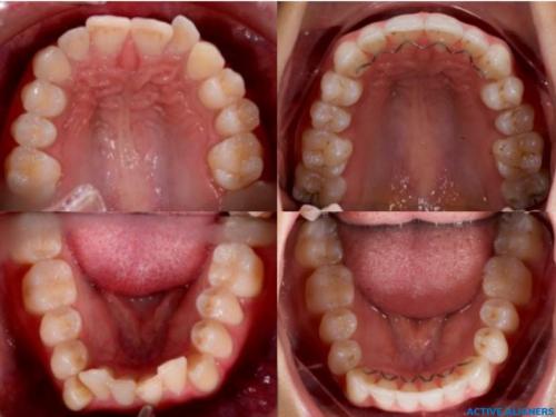 Active Aligner results